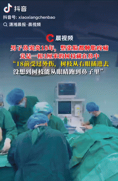 “活久见!”9月9日广东一男子常年鼻塞和流鼻血,去了无数次医院,医生都说是鼻窦炎