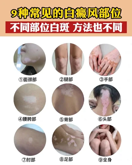 9种常见的白癜风部位不同部位白斑 方法也不