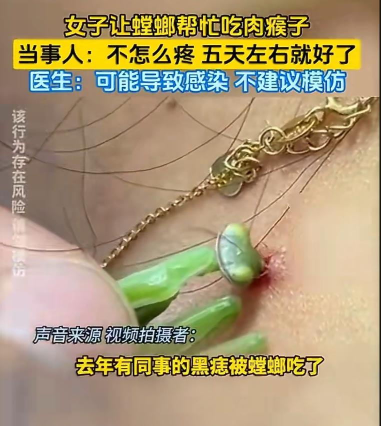近日，一女子让螳螂啃食自己颈部的“肉瘊子”，还称效果显著、不疼。视频一出，网友惊