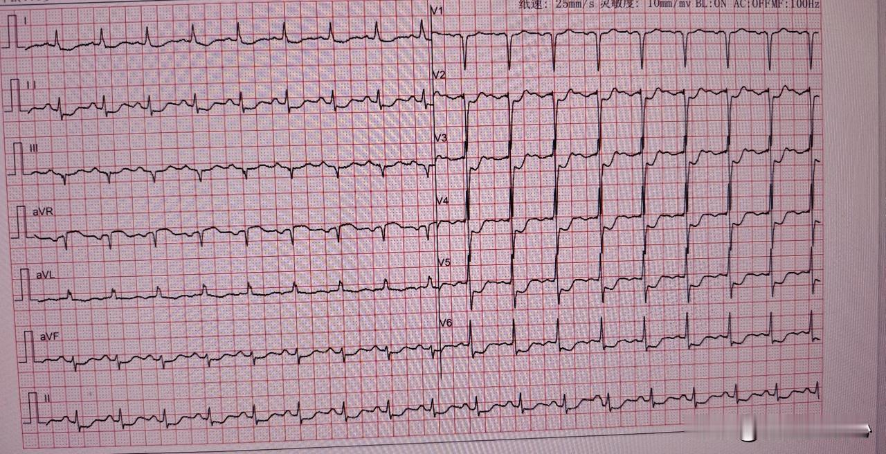 73岁女性，间断性胸痛一个月来门诊看病，发病特点是轻微活动后就会出现胸痛，持续几