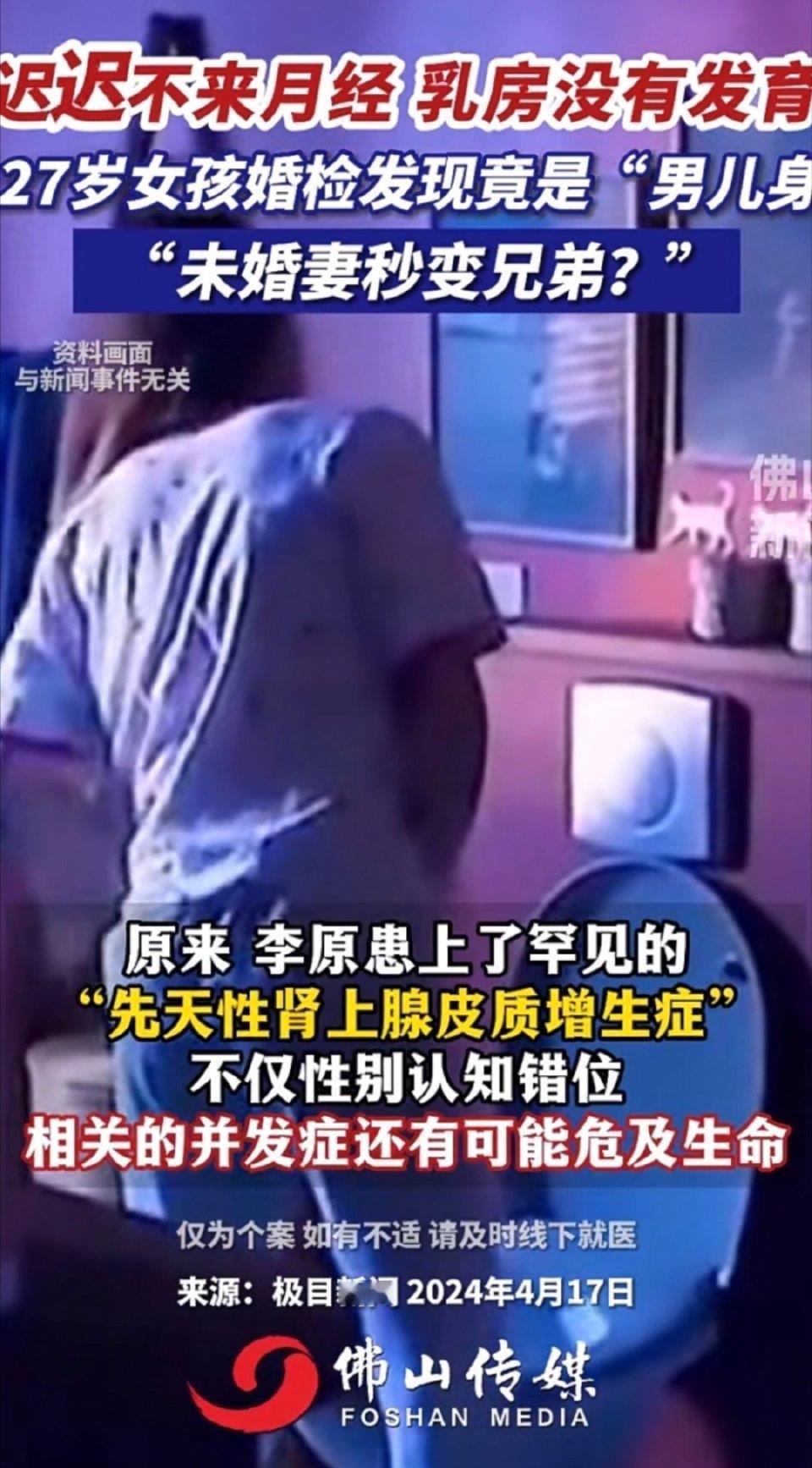 27岁姑娘准备结婚，却发现自己从来没来过月经，一查染色体居然是男性（46,XY）