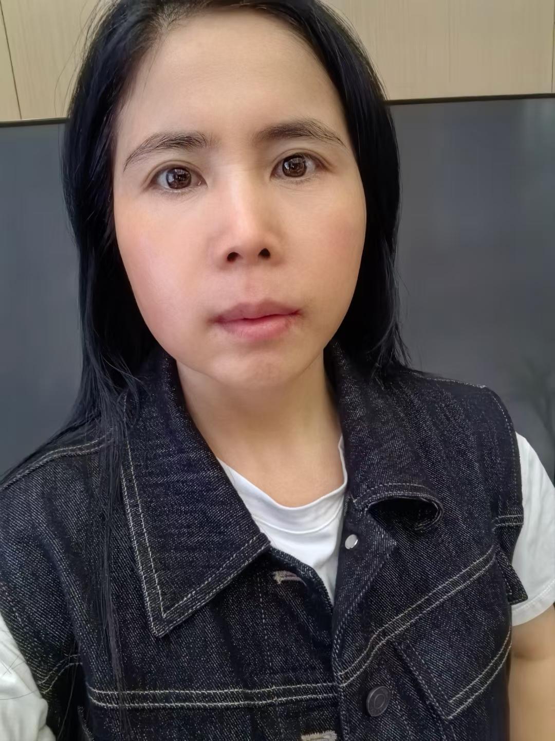 四颗种植牙附赠“包子脸”体验卡😭🫣60小时后慢慢消肿，五天后终于从...