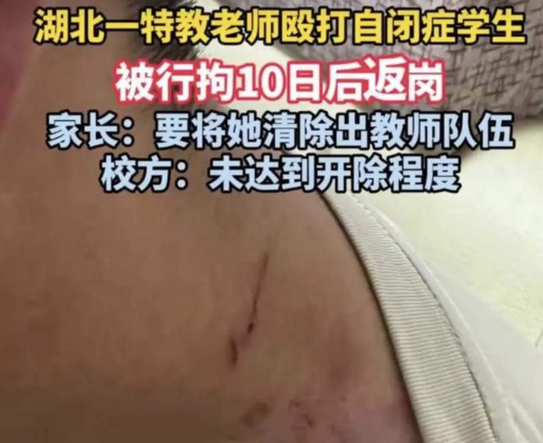 湖北恩施，特教老师被17岁自闭症男学生抓住头发后，情急反击被拘10日，出来后学生