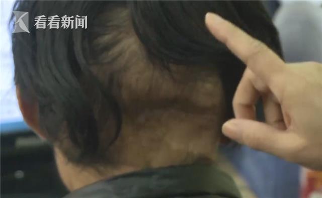 23岁小伙抗癌6年, 捐赠遗体给红十字会(附癌前信号)