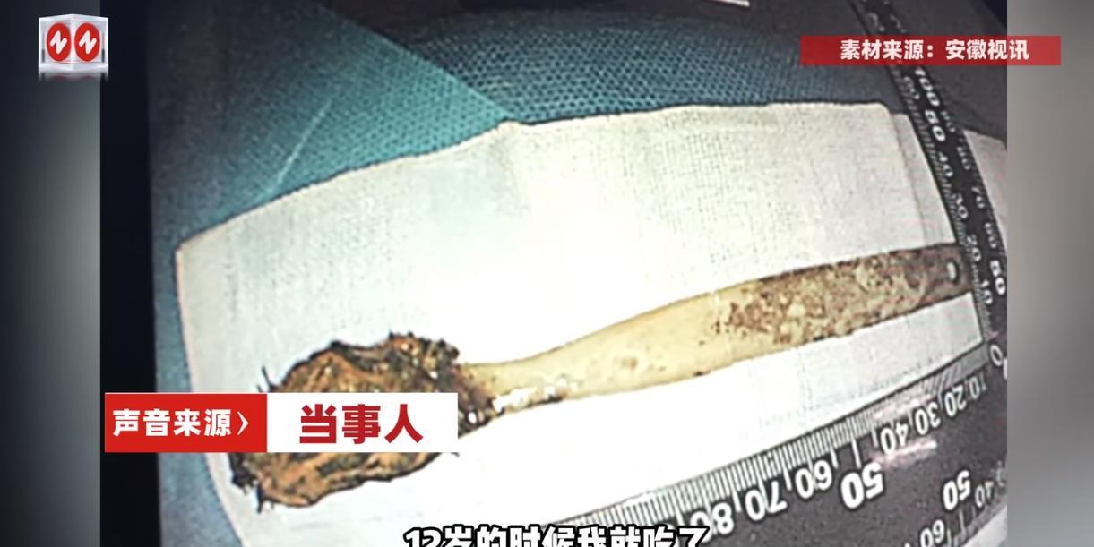 “离了个大谱！”安徽全椒，一位64岁的老人因为险些肠穿孔住进医院，医生通过内镜发