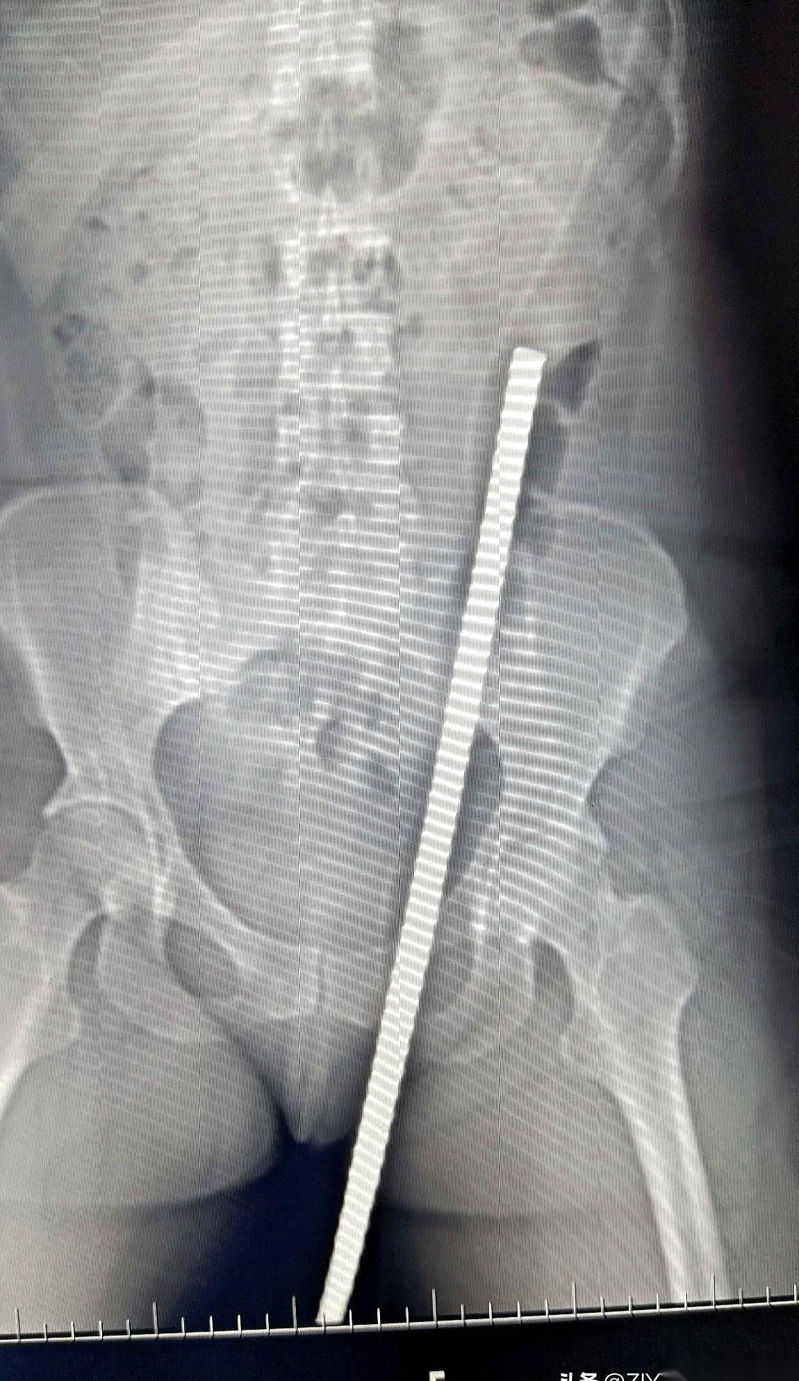 急诊室的门一推开，所有人的声音都小了下去。担架上躺着一个女人，47岁，工地上干