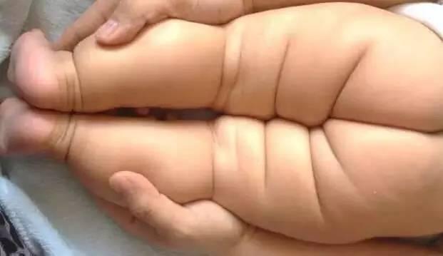 宝宝臀纹不对称?