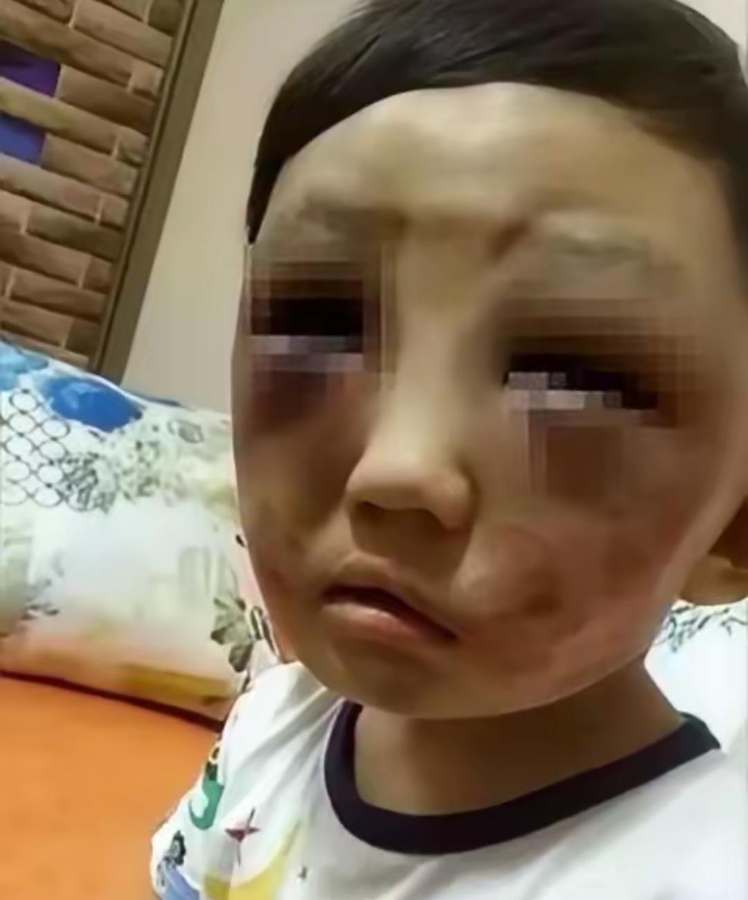 走了整整一天啊，一个才6岁的小豆丁。当妈的拽过孩子一看，青一块紫一块。颤着声问