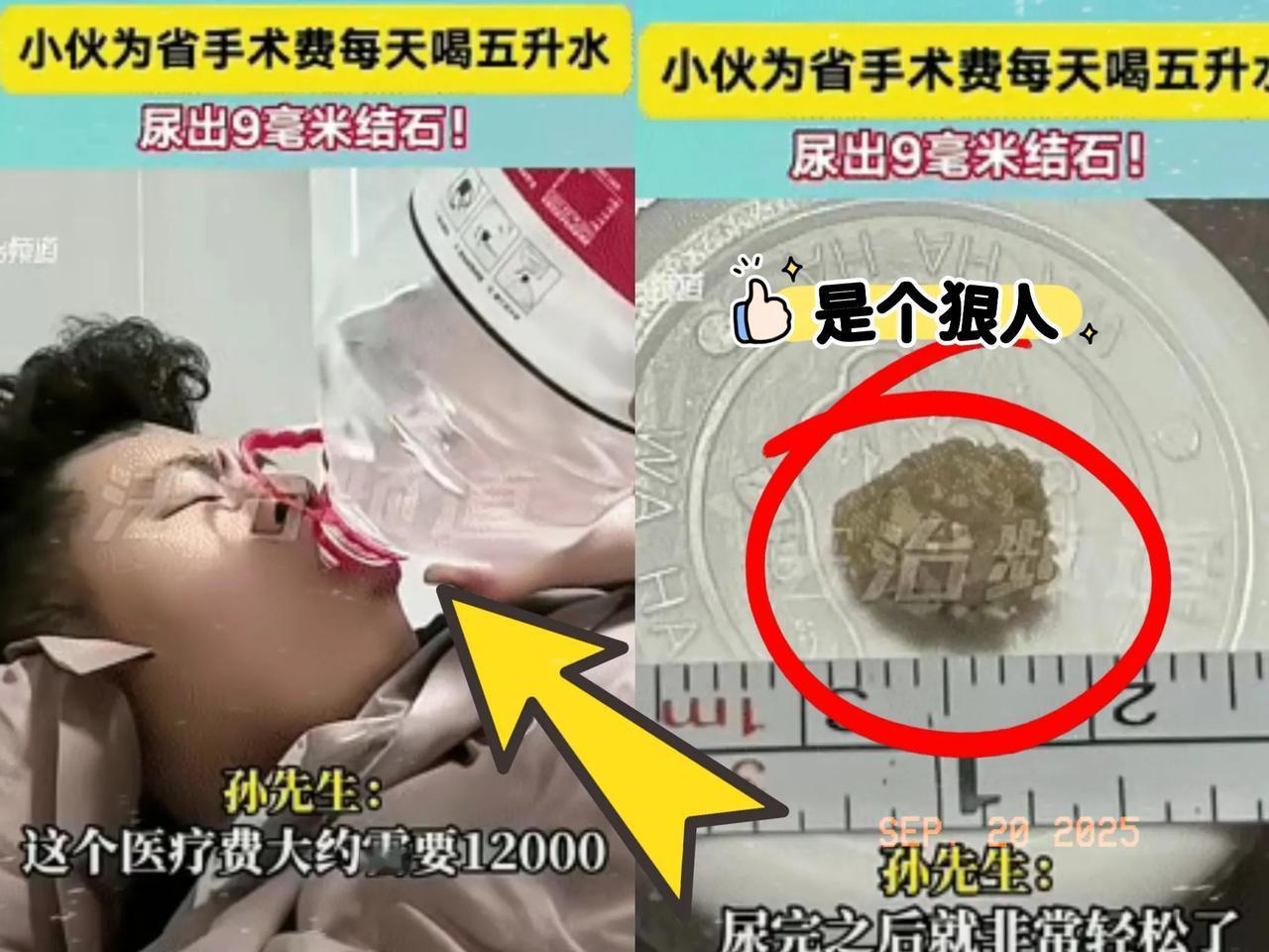 这人可太狠了！为了省手术费，竟然这样对自己孙先生去医院查出左肾有结石，一听