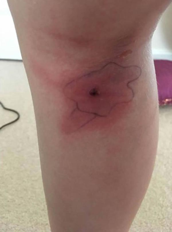 8岁女童出现流感症状伤口爆裂跑出一只蜘蛛