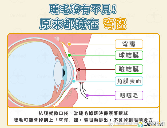 睫毛掉进眼睛里钙化了进到眼睛里的异物（如灰尘、睫毛）绝对不会跑到眼球后面，因为