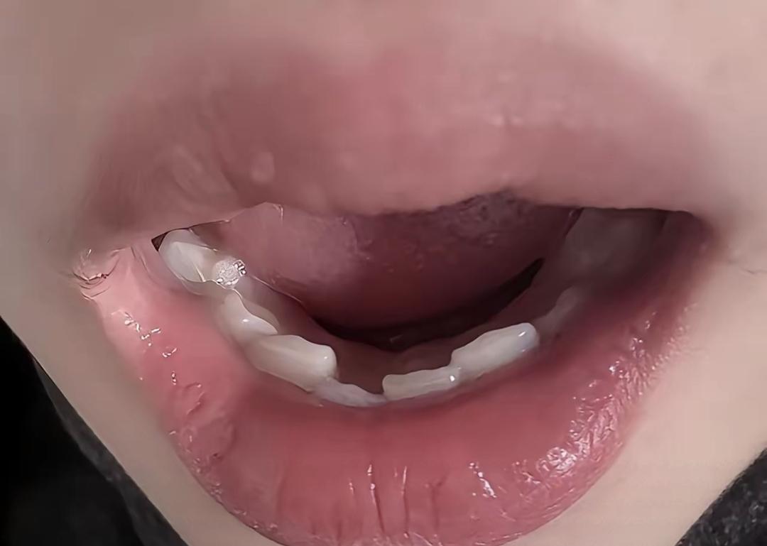 牙齿刚摘掉那会儿挺齐的，结果不到两年就歪了。我真以为戴上牙套、摘下来就完事了，