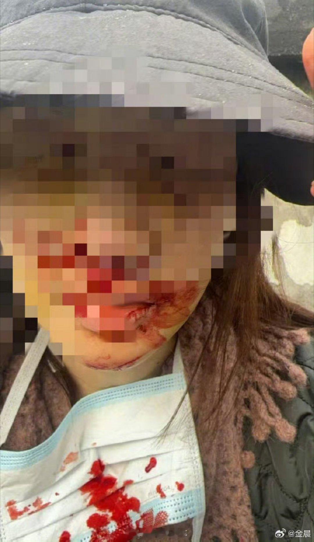 总感觉金晨事件被狗仔曝光出来有点蹊跷，一年多前的事，当时的确她的确受伤严重，唯一