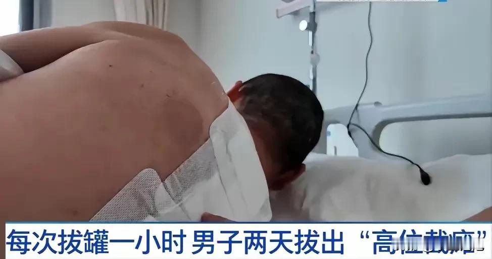 “心真大！”湖北一男子背疼不去医院，觉得是湿气大，自己买火罐在家拔，每次拔1小时