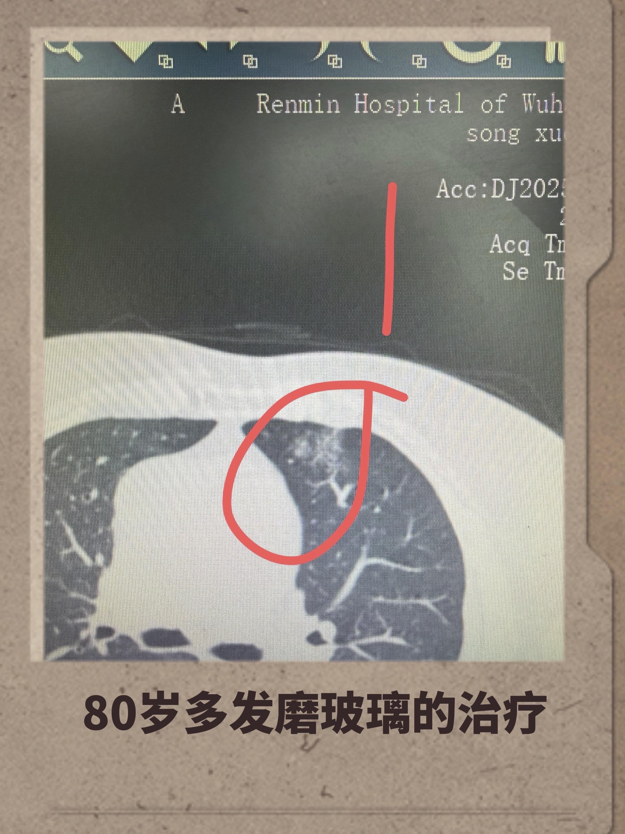 分享一个80岁多发结节的案例！如何治疗结。这个婆婆有4个有癌性磨玻璃结...