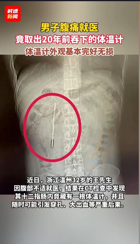 “万物皆可吞？”近日，浙江温州，一男子腹痛就医，结果竟然发现肠子里有一根体温计，