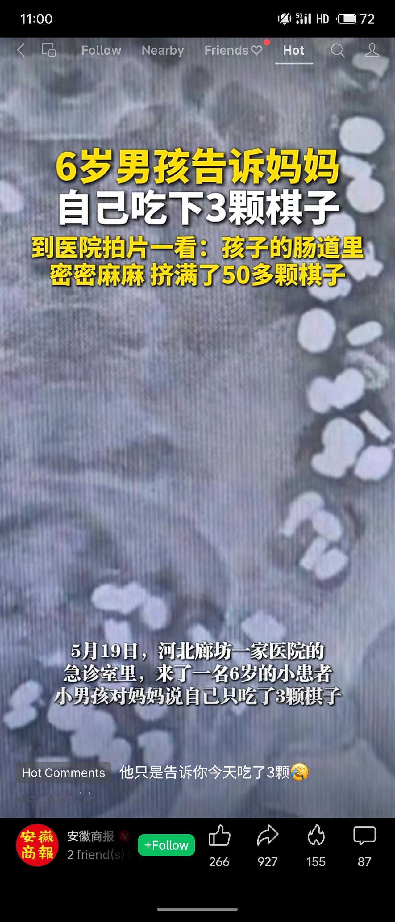 6岁男孩自称吞下3颗棋子，拍片却发现肠道挤着50多颗。医生用药后已排出20多颗。