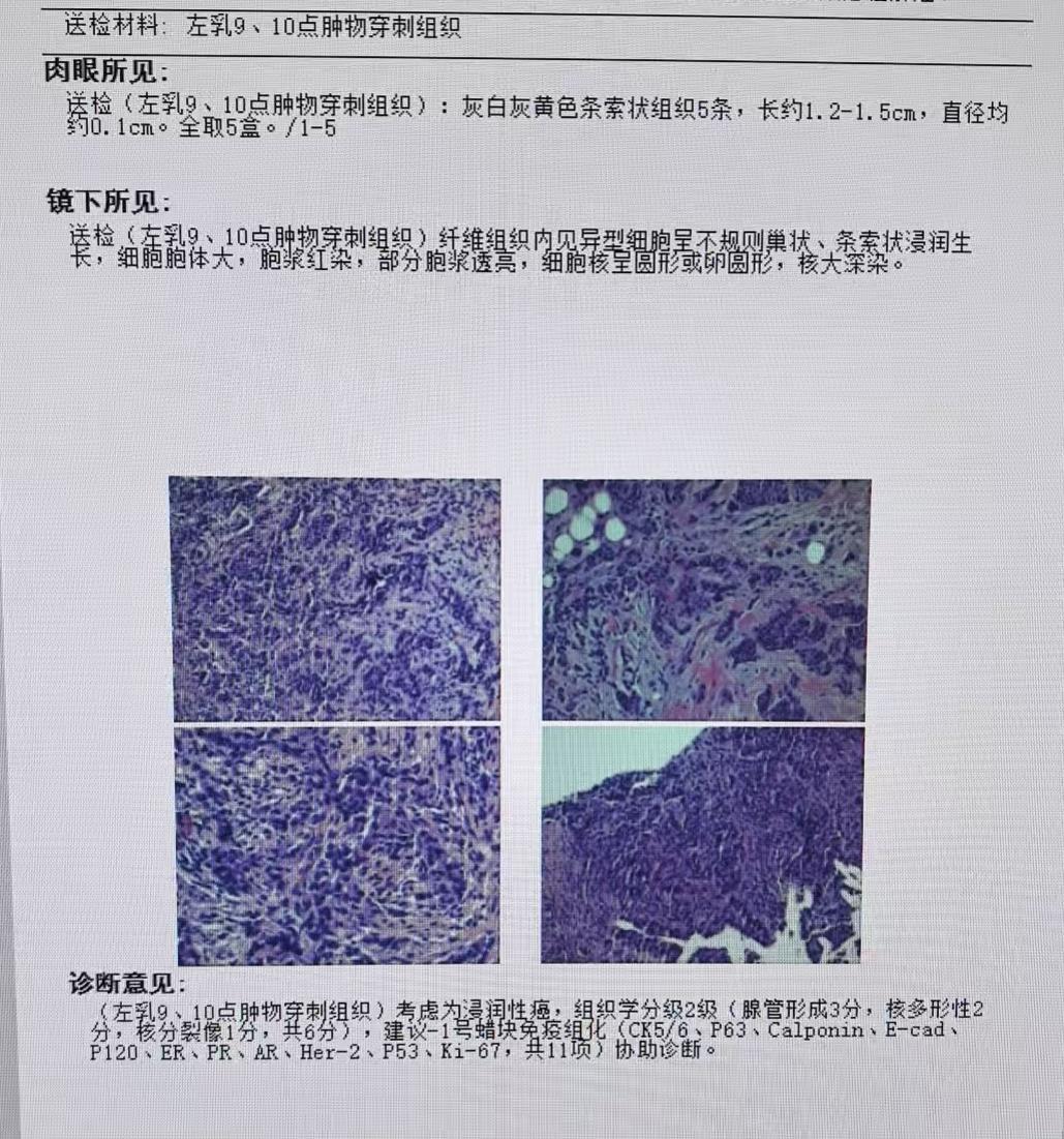 上周五出诊发现的那两个乳腺癌的病理结果都出来了，都证实了我的诊断，这进一步验证了