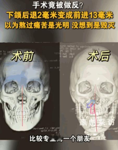 湖北武汉，一24岁模特因轻微“地包天”做正颌手术，原计划下颌后移2毫米，医生竟反
