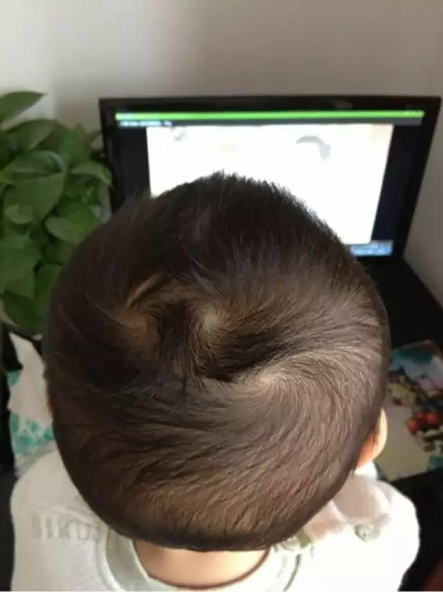 为什么有的宝宝头上有两个旋?