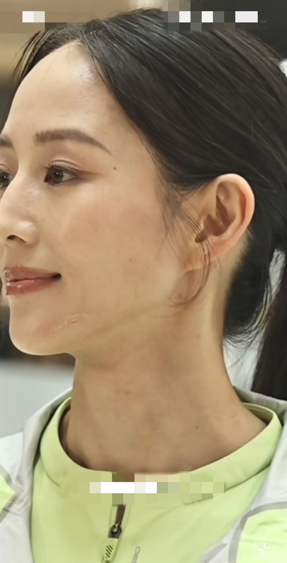 8月7日，张钧甯参加线下活动，远看有少女气息，怼脸拍脸上的痣好多，皮肤挺黑的，还
