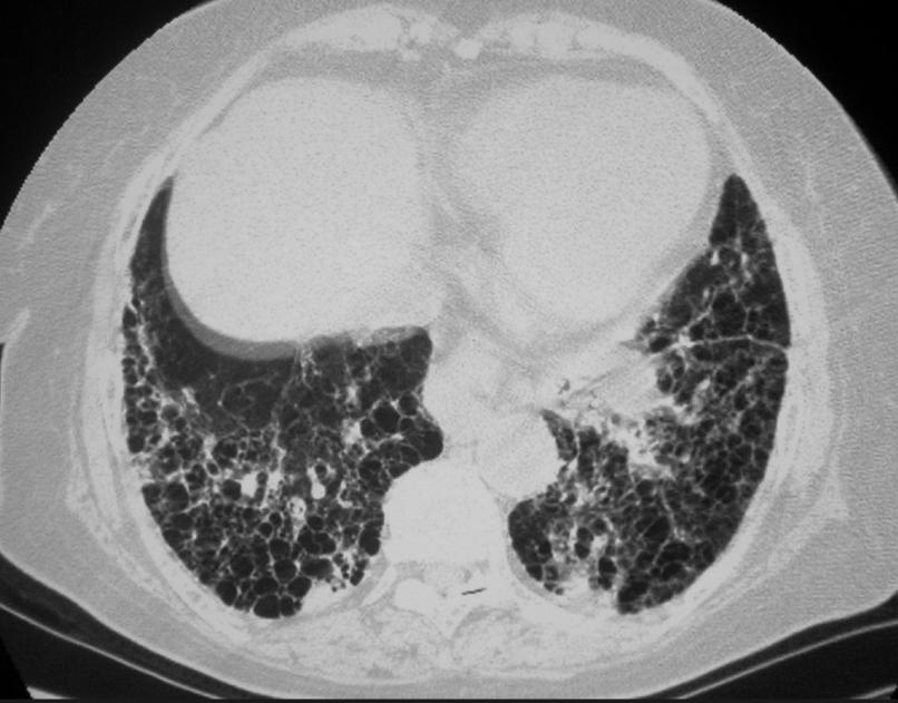 一个奇效古方，名气不大，却是肺纤维化专方每一次呼吸都变得费力，持续的、撕心裂