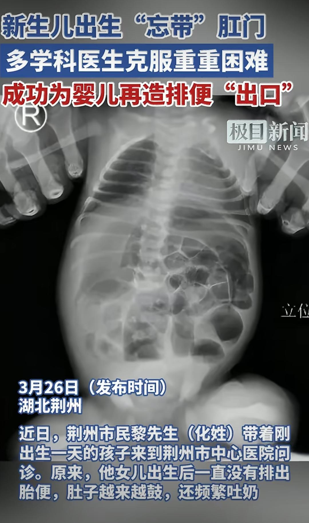 女婴出生一天无肛门，医院紧急手术成功救治湖北荆州一对夫妻，抱着刚出生没多久