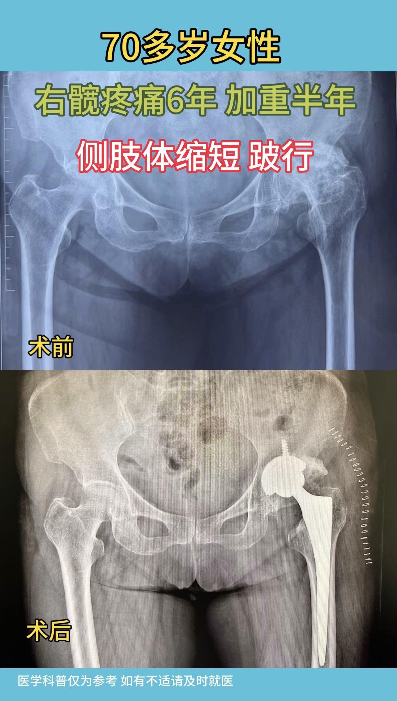 女性患者，70多岁，右髋疼痛6年，加重半年，患侧肢体缩短，跛行。由于股...