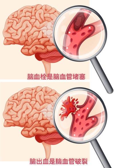 脑梗死与脑出血：了解它们的本质区别脑梗死和脑出血都是最常见的脑血管疾病，临床