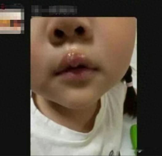 枉为人师！江苏徐州，丰县某幼儿园，有个小孩在园里上学，结果被老师拿热熔胶故意往嘴