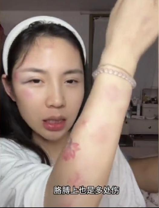 北京，女子下班回家路上，突然下起鸡蛋大的冰雹，没地方躲，身上被砸伤，脚还崴了，只
