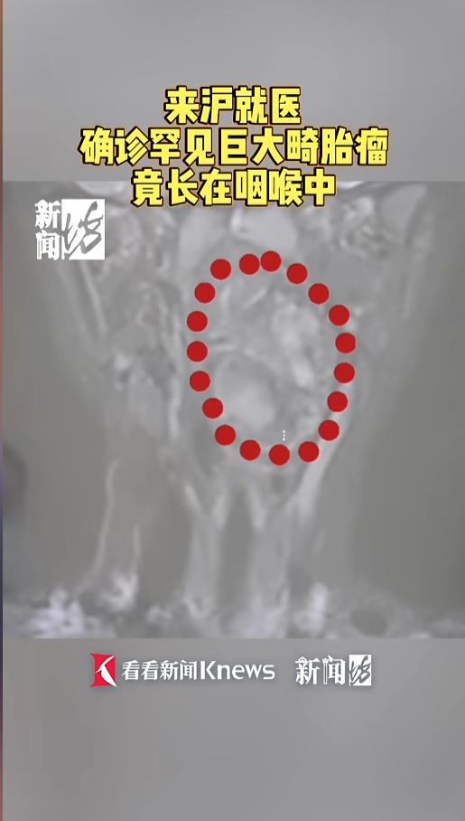 “太吓人了！”近日，上海，一位母亲带着孩子来求医。孩子打呼噜越来越响，吃饭也只吃