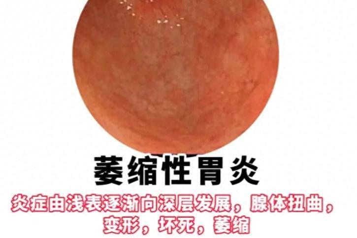 萎缩性胃炎！李东垣1剂千古名方，重获食欲，99%的患者脾胃好了！大家好，