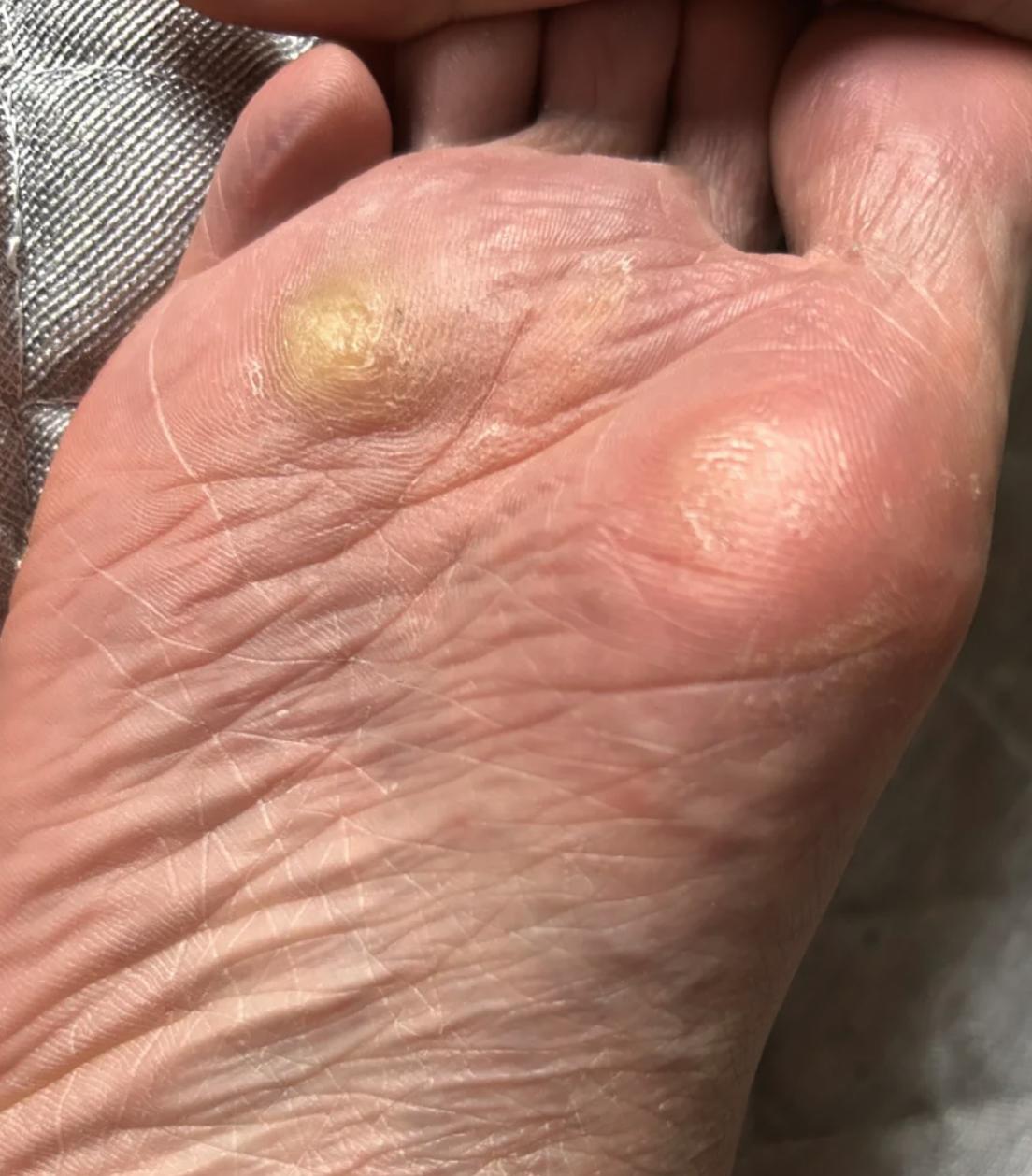 脚底板是HPV感染的“监测站”！4种迹象是HPV“难转阴”信号！抓住清除病毒黄金