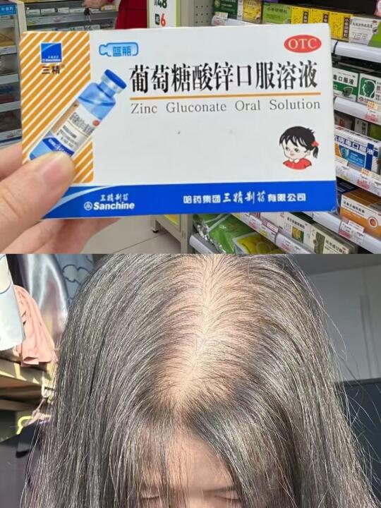 关于脱发的大实话......