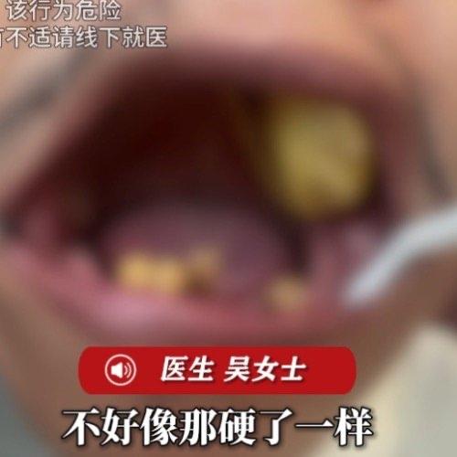 刷到东莞一个大叔的经历，真的又好笑又心疼。他牙齿掉了没去医院，自己在网上买了所谓