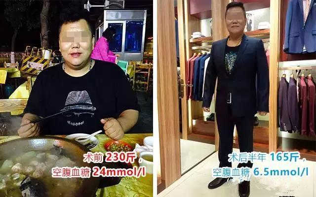 胃旁路手术一箭双雕治好“肥胖”与“糖尿病”