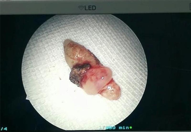 63岁种植牙血泪史：8颗下牙+5颗上牙折腾1年，广告里没说的痛苦全经历了！