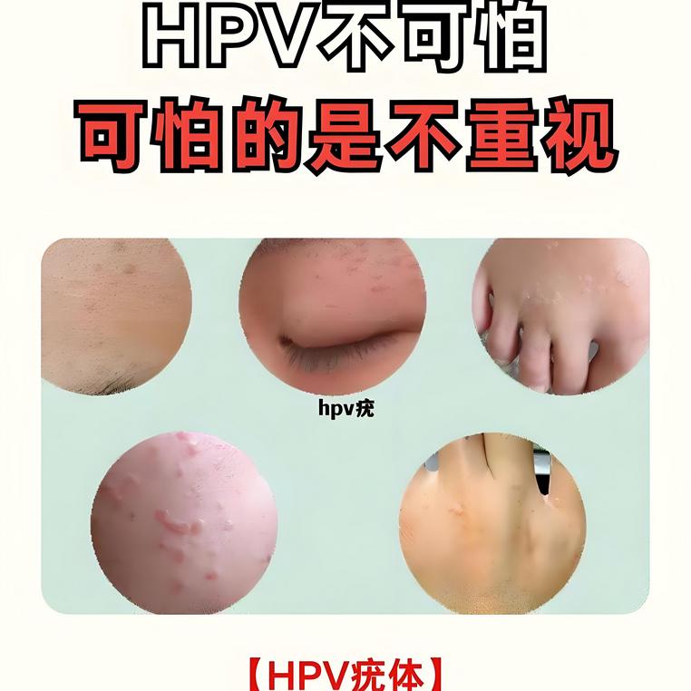 不论男女，身上长出这5种“瘊子”，或已感染HPV病毒！请不要轻视李阿姨不喜欢