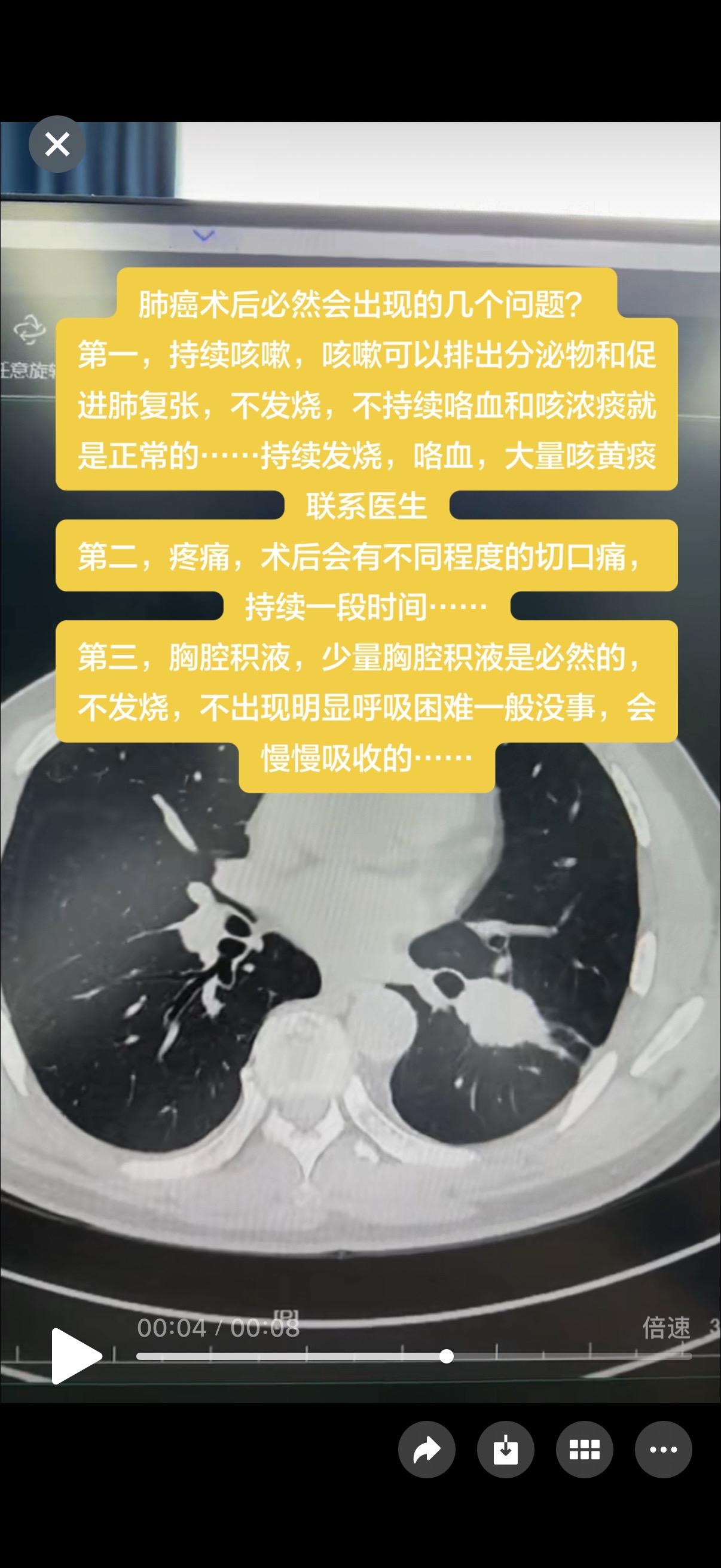 肺微创手术后的一些问题……肺癌术后必然会出现的几个问题？ 第一，持续咳...