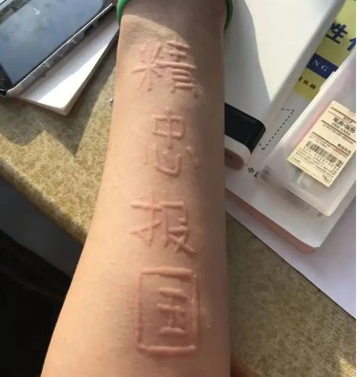 划痕型荨麻疹西医取名很有意思，比如划痕性荨麻疹，荨麻疹就是有包，越抓越多，发