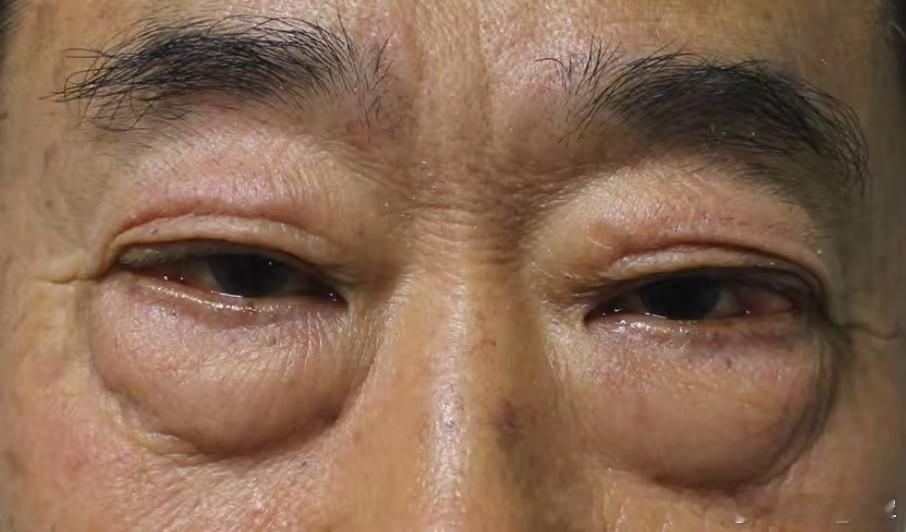 人过五十眼袋大中药验方​在中医理论中，下眼袋大（又称“目胞浮肿”“眼袋”）的核