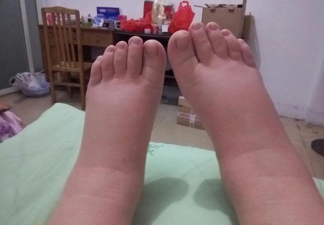 肾脏功能衰退通常让人联想到水肿、疲劳或腰背疼痛。很多老年人常忽视一些微小症状，认