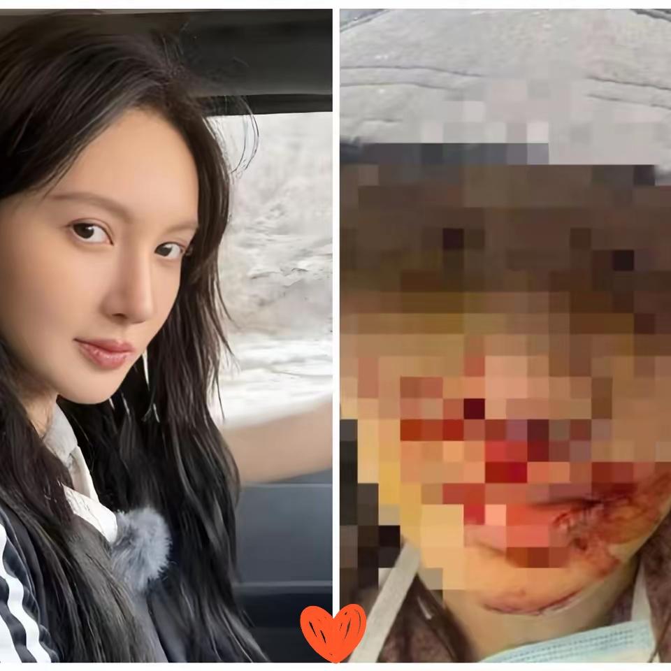 我问整形朋友，金晨绍兴撞得满脸是血，为啥舍近求远非要去上海医院？