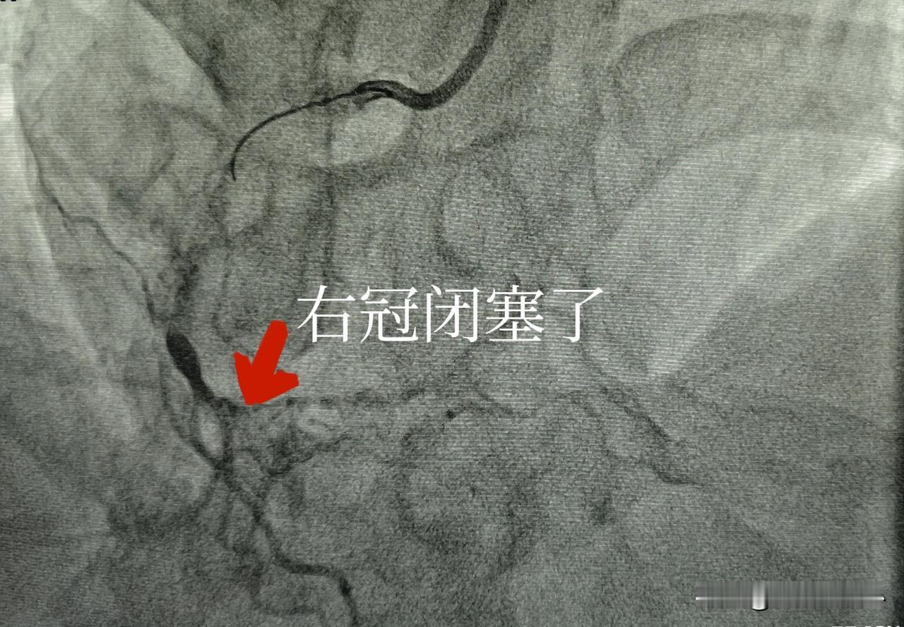 堵塞血管开通又一例。今天这位患者是一个56岁的男性患者，5年前就发现了冠心