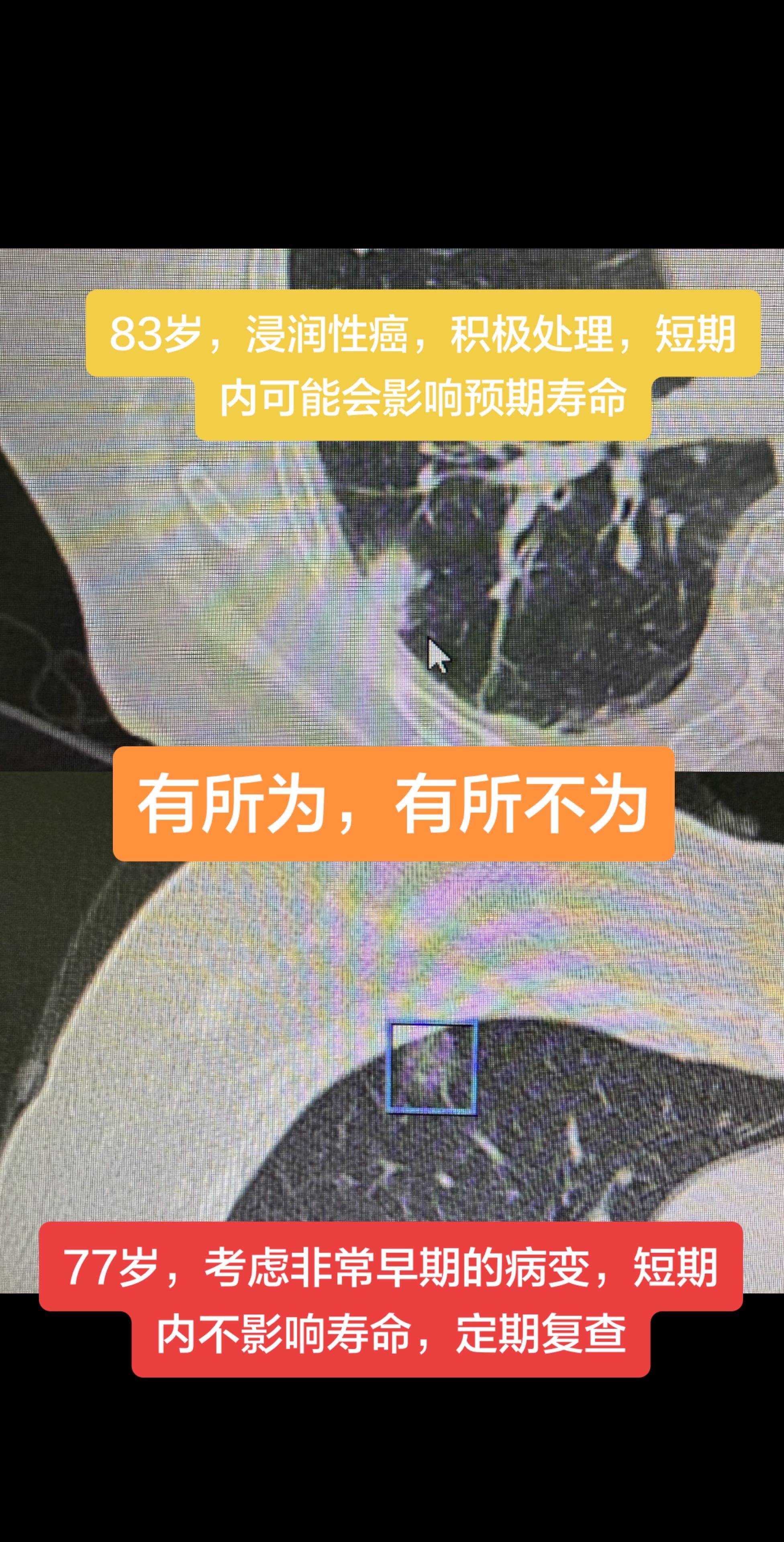 实性肺癌容易发生转移，危险性高，只要身体条件可以，应该积极处理……磨玻...
