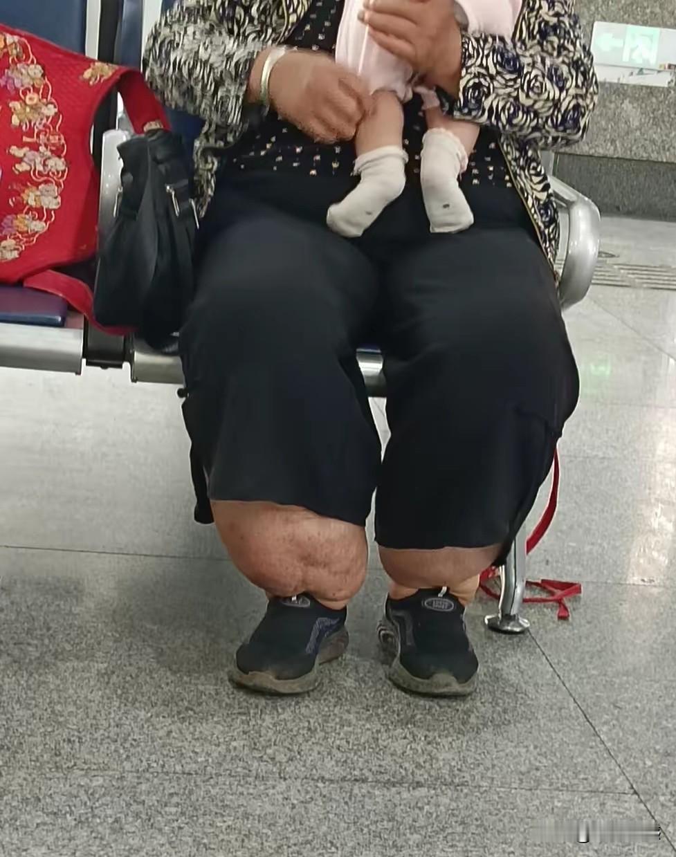 这个人的腿怎么这么粗？感觉大腿和小腿一样粗，和大象腿一样，这是非常不正常的事情，