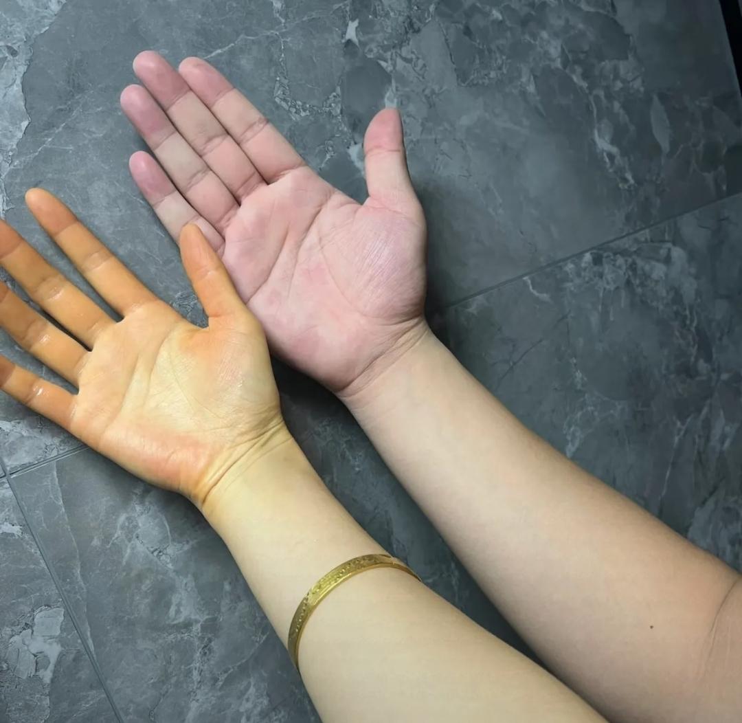 千万不要吃多黄色的食物，年纪轻轻我就得了皮肤黄染，我喝了整整半年的沙棘，果汁