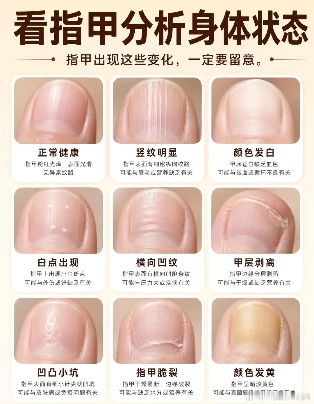 看指甲分析身体状态​​​