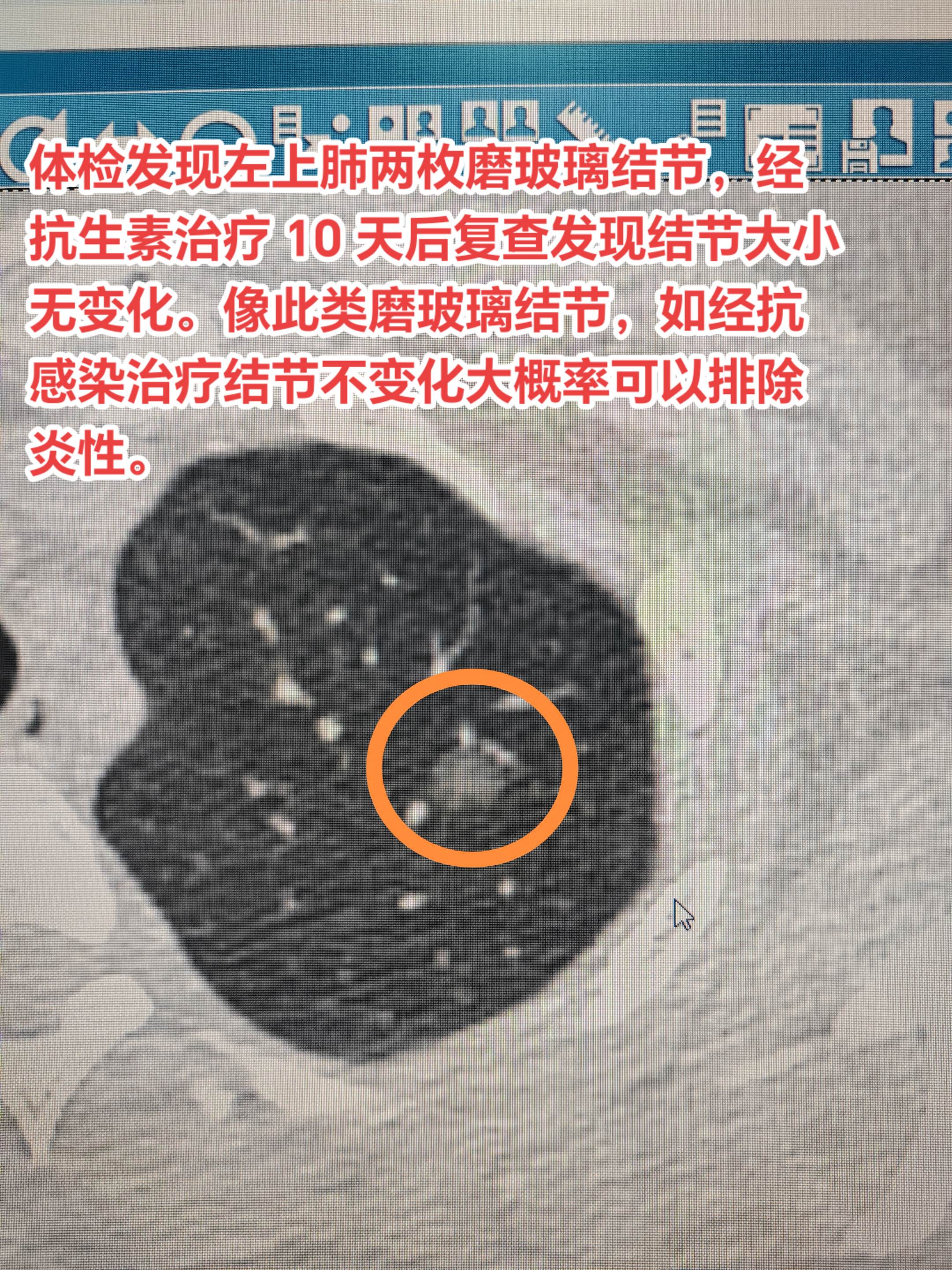 如何鉴别磨玻璃结节良恶性？体检发现左上肺两枚磨玻璃结节，经抗生素治疗 ...